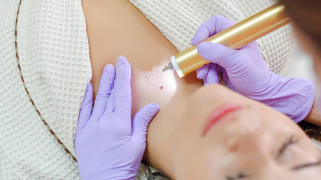 Beauty Services in warrington SV Laser Skin