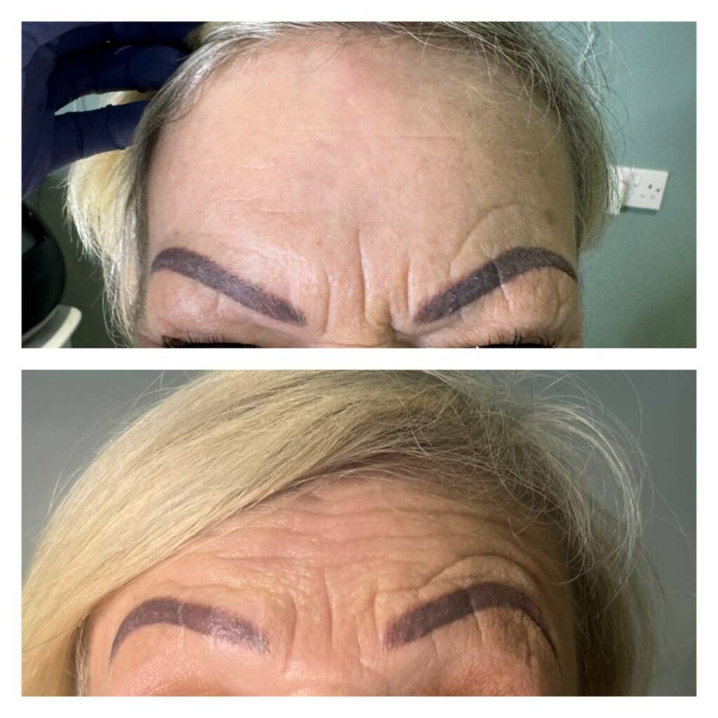 botox warrington